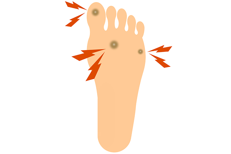 うおの目（鶏眼）