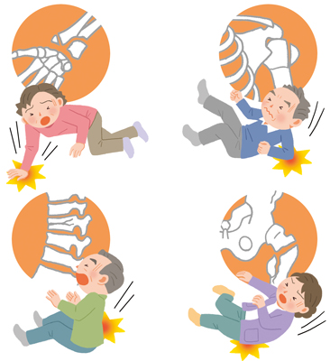 骨折について