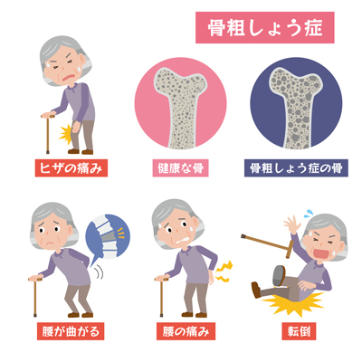骨粗しょう症について